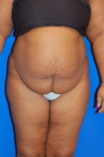 Liposuction Mobile, Alabama