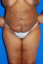 Liposuction Results Mobile, Alabama