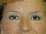 Eyelid Surgery