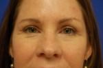 Eyelid Surgery