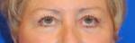 Eyelid Surgery