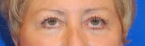 Eyelid Surgery