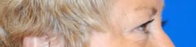 Eyelid Surgery