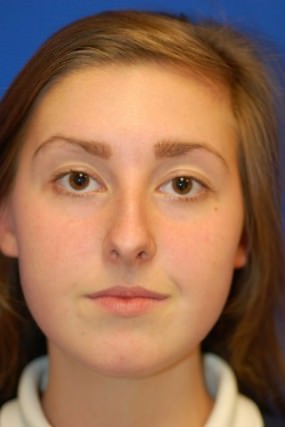 Rhinoplasty