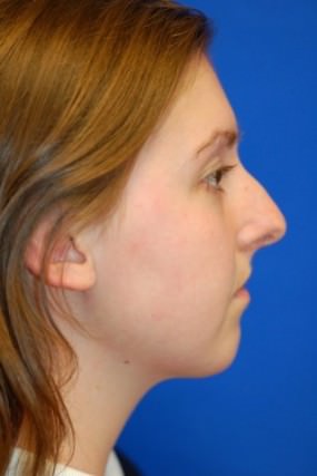 Rhinoplasty