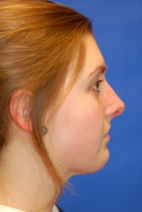 Rhinoplasty