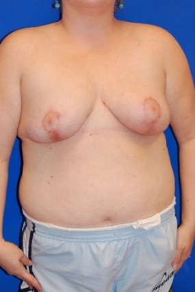 Breast Asymmetry