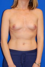 Breast Augmentation