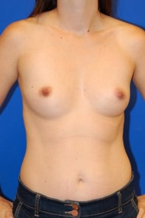 Breast Augmentation