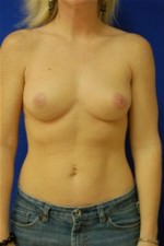 Breast Augmentation