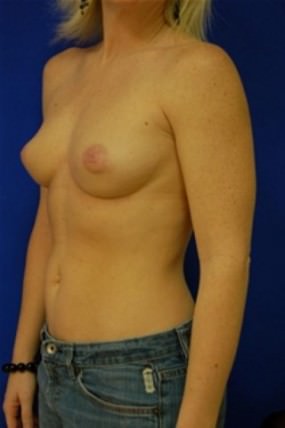 Breast Augmentation
