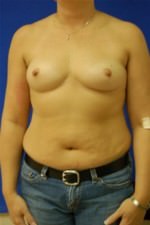 Breast Augmentation