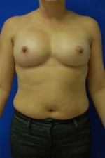 Breast Augmentation