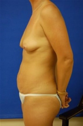Breast Augmentation