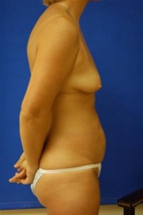 Breast Augmentation