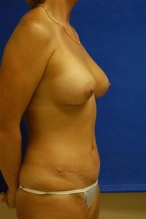 Breast Augmentation