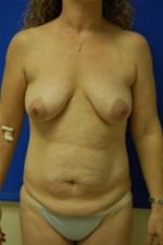 Breast Augmentation