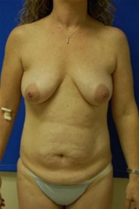 Breast Augmentation