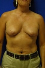 Breast Augmentation
