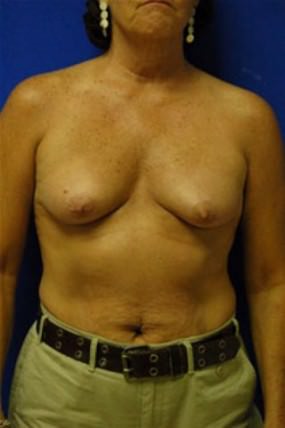 Breast Augmentation