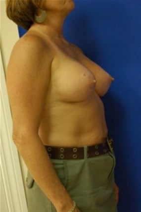 Breast Augmentation