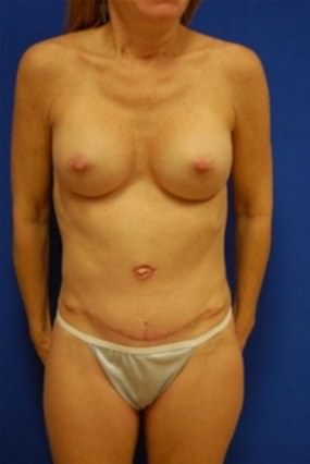 Breast Augmentation