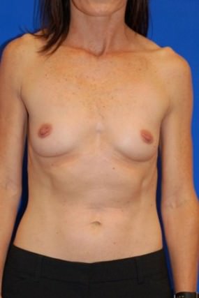 Breast Augmentation