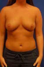 Breast Augmentation