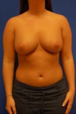 Breast Augmentation
