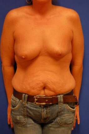 Breast Augmentation