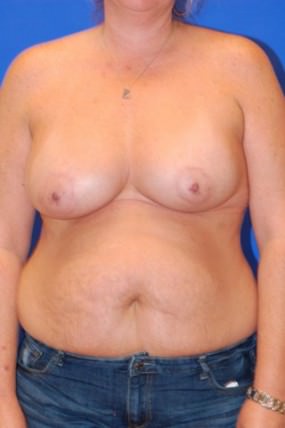 Breast Augmentation