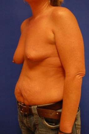 Breast Augmentation