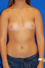 Breast Augmentation