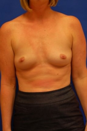 Breast Augmentation