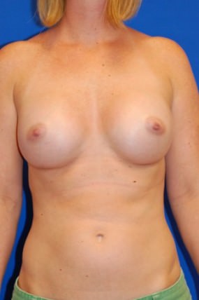 Breast Augmentation
