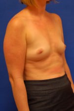 Breast Augmentation