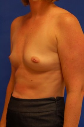 Breast Augmentation