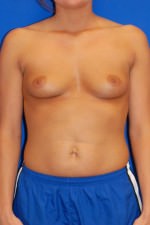 Breast Augmentation