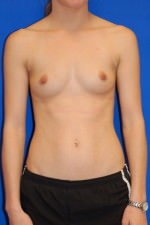 Breast Augmentation