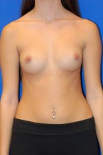 Breast Augmentation