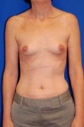 Breast Augmentation