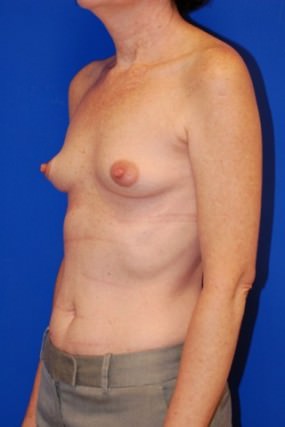 Breast Augmentation