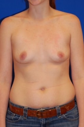 Breast Augmentation