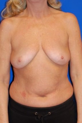 Breast Augmentation