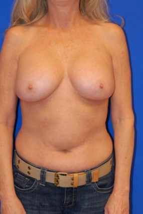 Breast Augmentation