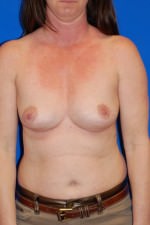 Breast Augmentation