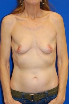 Breast Augmentation