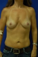 Breast Augmentation