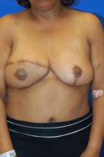 Breast Reconstruction