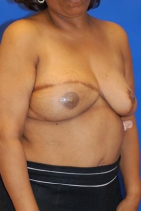 Breast Reconstruction